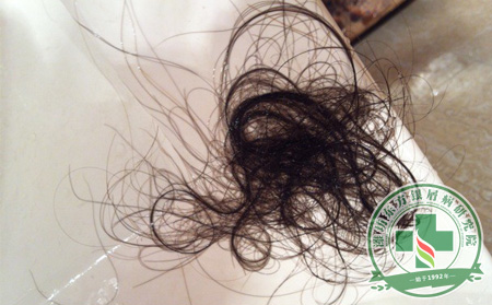 銀屑病遇上脫發(fā),哪個(gè)環(huán)節(jié)應(yīng)該重點(diǎn)護(hù)理