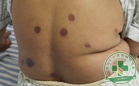 銀屑病護理方法