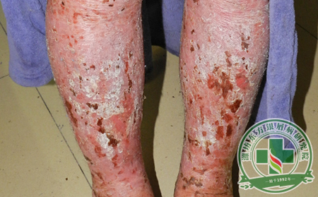 關(guān)節(jié)型銀屑病的癥狀是如何引起的