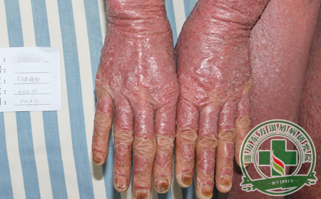 紅皮型銀屑病治療