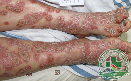 患者發生關節型銀屑病的癥狀預兆