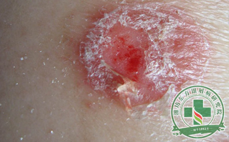 談癥狀：怎樣與膿皰型銀屑病進行長期斗爭