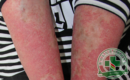 得了尋常型銀屑病憂心忡忡，患者可以這么做