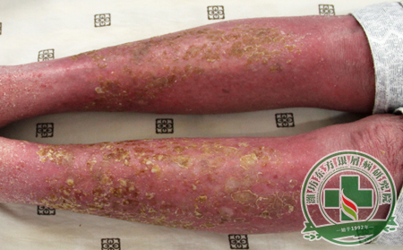 紅皮型銀屑病治療