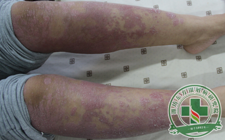 無風不起浪，銀屑病產生的根本原因是什么?