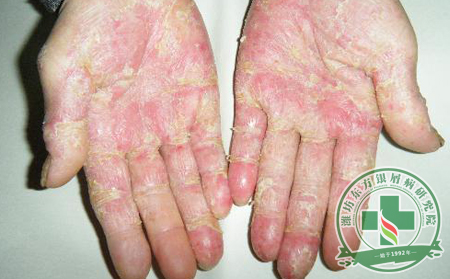 銀屑病患者剝撕鱗屑等于將健康扔掉