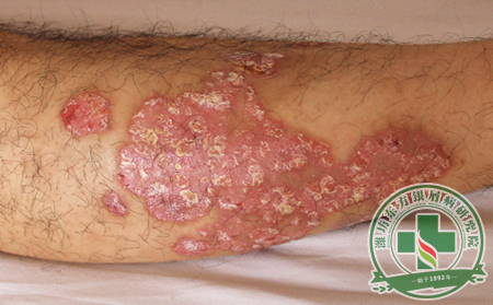 患者日常怎么做才能避免膿皰型銀屑病惡化加重?