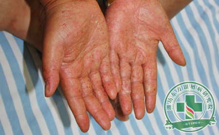 手部長了銀屑病，您知道怎么護理才能更快好的它嗎?