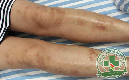 錯誤觀念影響大，會如何阻礙銀屑病的臨床治療?