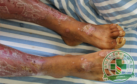 銀屑病間隔不久頻繁復發原因究竟在哪里?