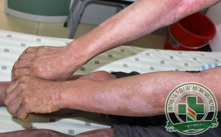 尋常型銀屑病惡化原因面面觀，了解過后有備無患