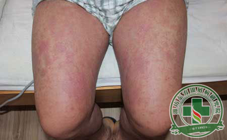 關(guān)節(jié)型銀屑病