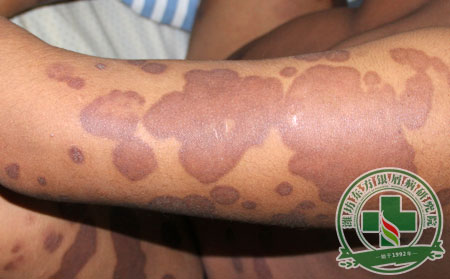 好的銀屑病后皮膚變黑已成定局，這該怎么辦