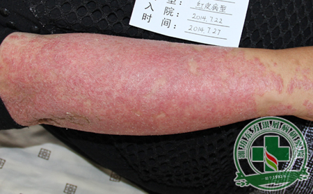 季節養生：銀屑病患者切忌過早過夏天