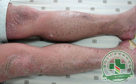 為了適應換季節奏，如何調整銀屑病的預防措施