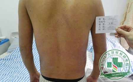 那些不可信的銀屑病治療方法是如何美化自己的?