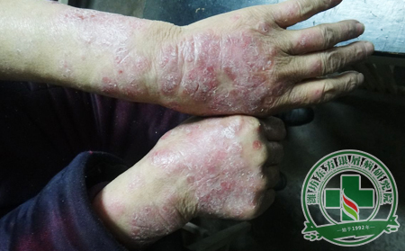 看看四肢銀屑病患者的護理指南