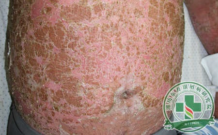 結合具體誘發實例談談銀屑病的患病因素是什么?