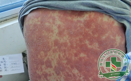 可收藏！向世人講述銀屑病綜合性常見問題