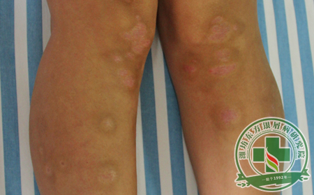 深入分析銀屑病之所以產生與哪幾大因素關聯緊密