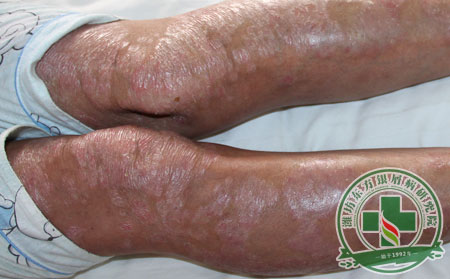 如何依靠科學的治療方法降服銀屑病