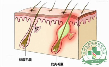 敏感性皮膚的銀屑病患者生活中要如何保養