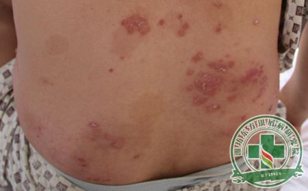 有助銀屑病患者夏季打個“翻身仗”的治療方法