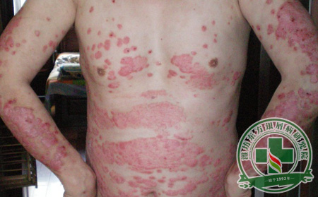 尋常型銀屑病與銀屑病有什么區別，癥狀是什么