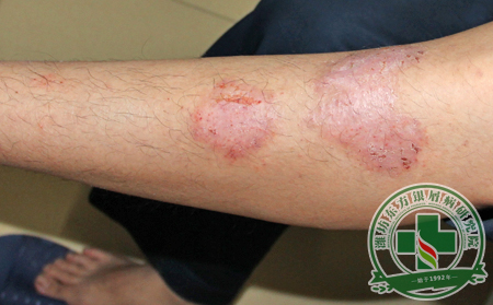 胳膊上出現層層銀屑，誘發因素又是為何?