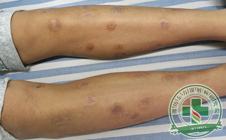 掌握三種治療思路今后治銀屑病不用愁