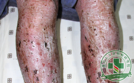 從預(yù)防到護(hù)理，膿皰型銀屑病的護(hù)理方略如何轉(zhuǎn)變?