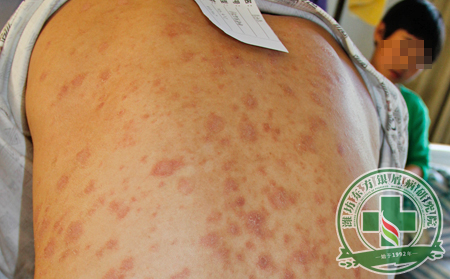 患者福音：剖析多種銀屑病治療方法的利弊