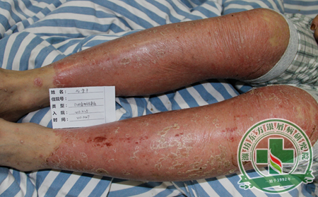 銀屑病持續擴散，此時采用哪些治療方法更見到效果?