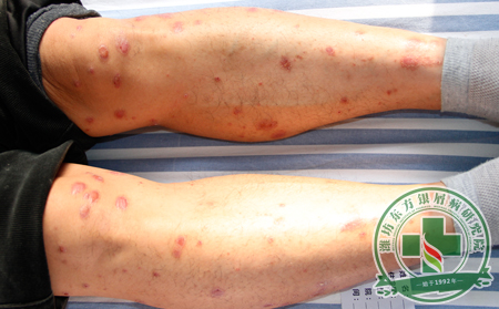 解讀為什么夏季治銀屑更利于發(fā)揮治療方法的功效?