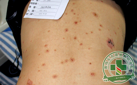 患者可通過尋常型銀屑病的皮損表現來診斷病癥發展