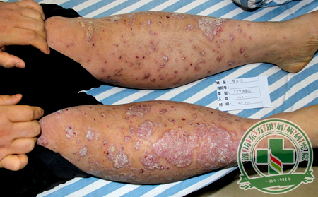 治療有方抗銀有術——治療銀屑病該怎么做?