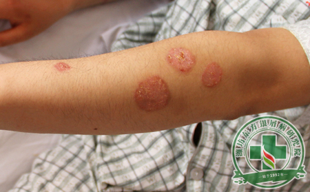 銀屑病治療