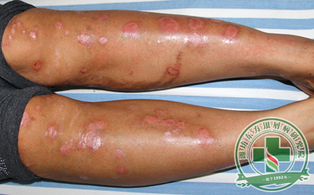 銀屑病治療