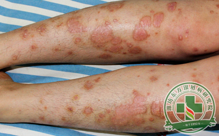 誘發因素實例分析：為什么一家人里只有我得了銀屑病