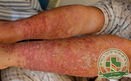 看清銀屑病治療過程中的幾個陷阱，讓患者找到出路