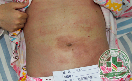 抓住夏季治療銀屑病的可以機會,患者如此護理更見到效果