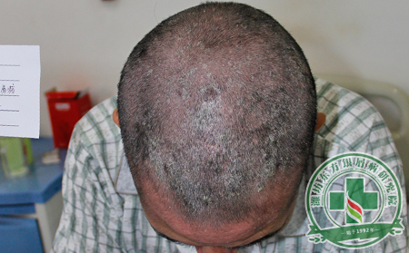科學探討有效治療頭部銀屑病的方法，讓患者茅塞頓開