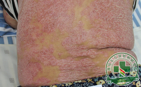 銀屑病治療