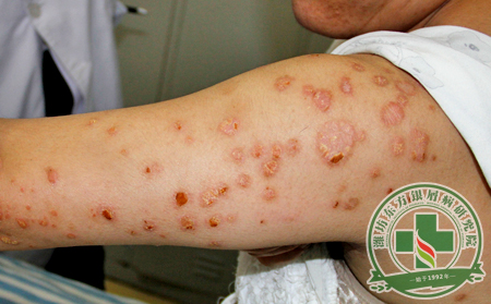 夏季烈日當頭,此時治療銀屑病能有哪些優勢?