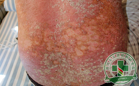 身上汗越多對銀屑病治療越有利?不當認知小心中暑