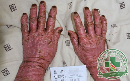 治療手指甲部位的銀屑病用治灰指甲的方法是不是也行?