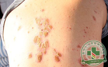 尋常型銀屑病患者的生活環境該維持在怎樣的水平?