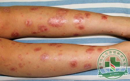 預防患有尋常型銀屑病的女性患者病情復發，可采取哪些方法?