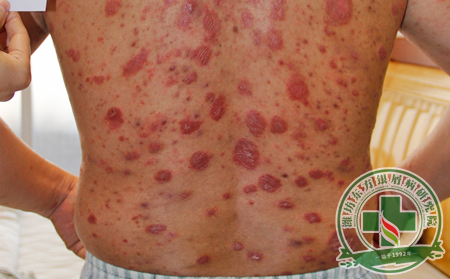 剛得的銀屑病用什么治療方法能夠治得可以