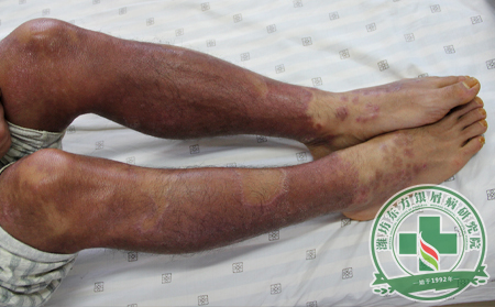 關(guān)節(jié)型銀屑病患者如何歡度夏日